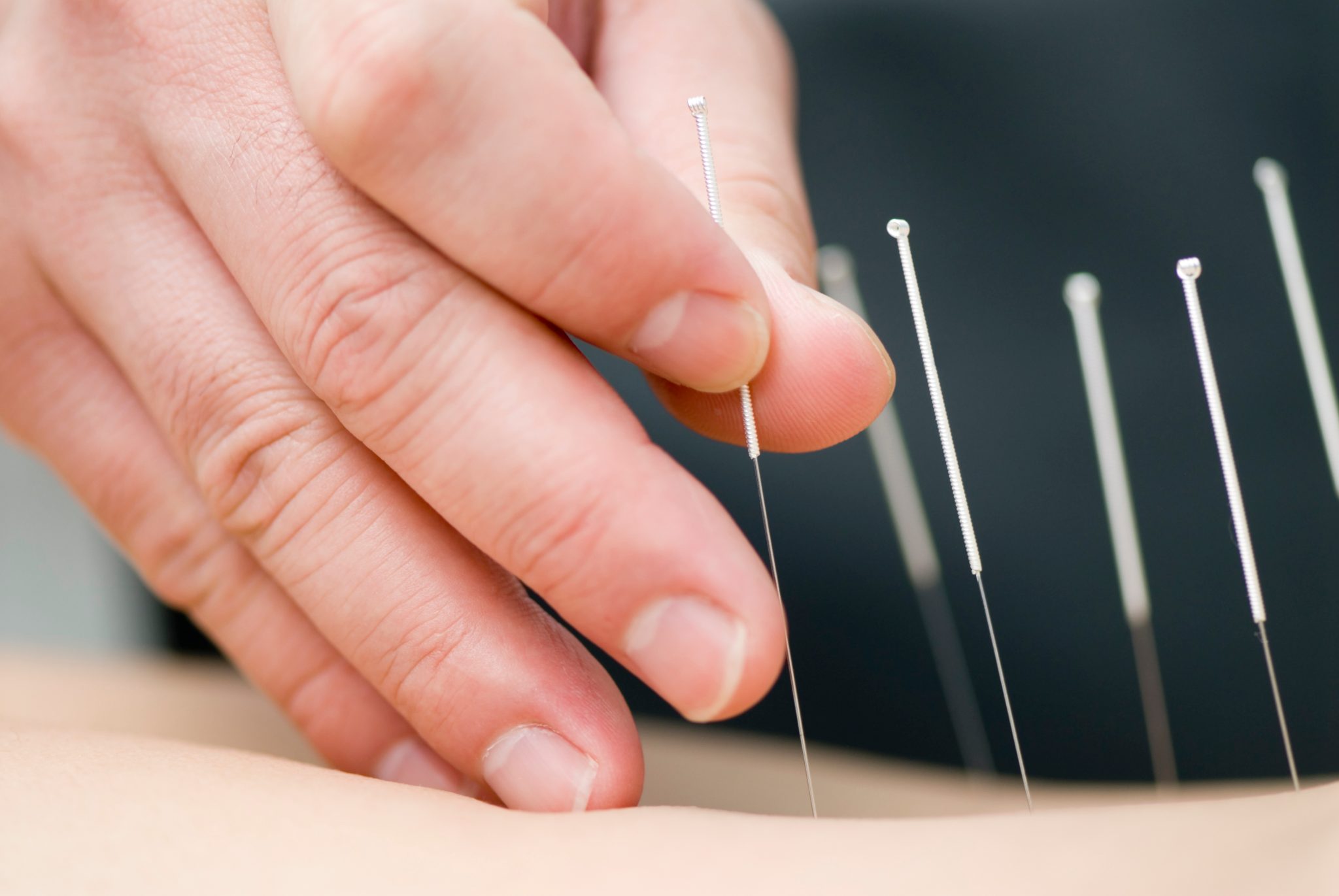 Practitioner placing a hair-thin acupuncture needle, close-up